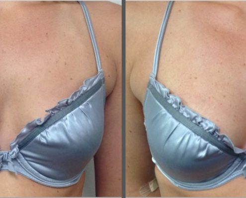 How Long Can Vampire Breast Lift® Results Last?